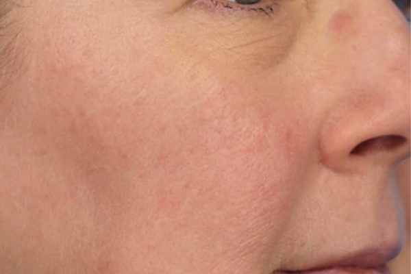After treatment: Before and after SkinPen Microneedling - 3 Treatments of SkinPen Microneedling – Brookfield WI