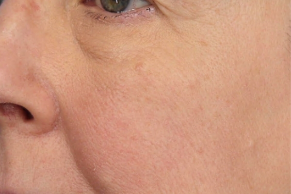 After treatment: Before and after SkinPen Microneedling - 3 Treatments of SkinPen Microneedling – Waukesha WI