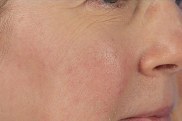 Before treatment: Before and after SkinPen Microneedling - 3 Treatments of SkinPen Microneedling – Brookfield WI