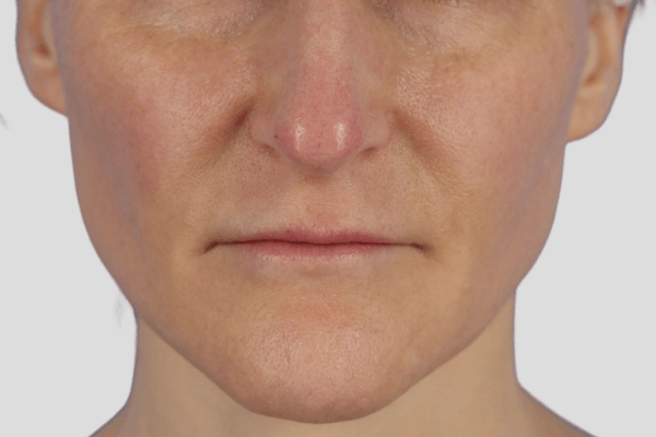 After treatment: Before and after SkinPen Microneedling - 3 Treatments of SkinPen Microneedling with PRP – Brookfield WI