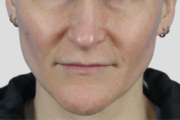 Before treatment: Before and after SkinPen Microneedling - 3 Treatments of SkinPen Microneedling with PRP – Brookfield WI