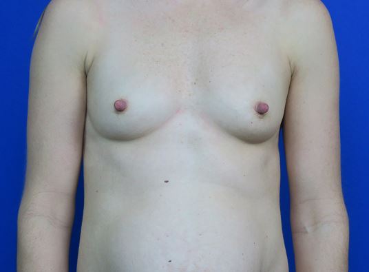 Before treatment: post birth breast augmentation surgery in Broofield