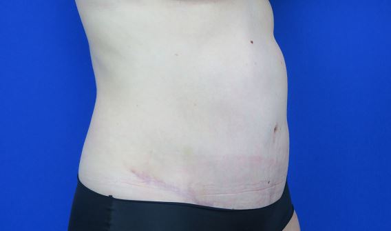 After treatment: Post birth plastic surgery before & after in Brookfield