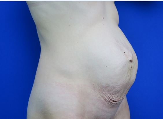 Before treatment: Post birth plastic surgery before & after in Brookfield