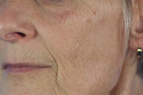 Before treatment: Before and after PRF Gel Bio Filler - 1 Treatment -  Oconomowoc WI