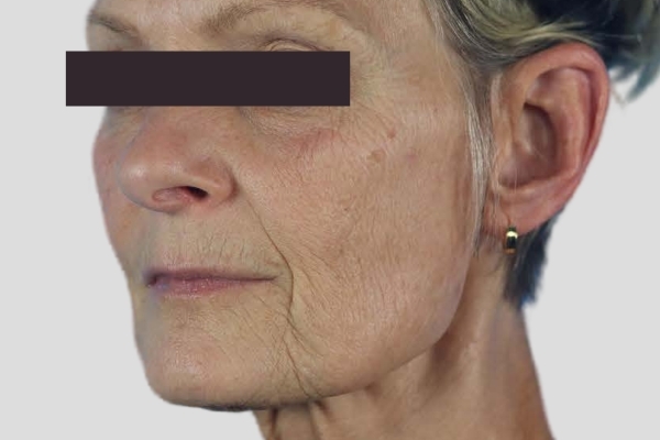 Before treatment: Before and after PRF Gel Bio Filler - 1 Treatment -  Brookfield WI