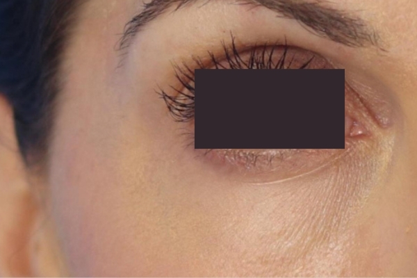 Before treatment: Before and after PRF Gel Bio Filler - 2 Treatments -  Delafield WI