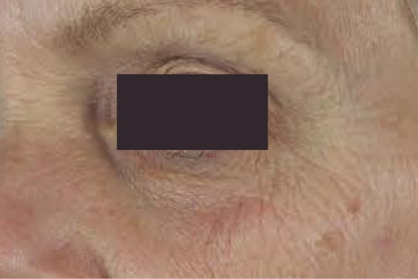 Before treatment: Before and after PRF Gel Bio Filler - 1 Treatment -  Brookfield WI
