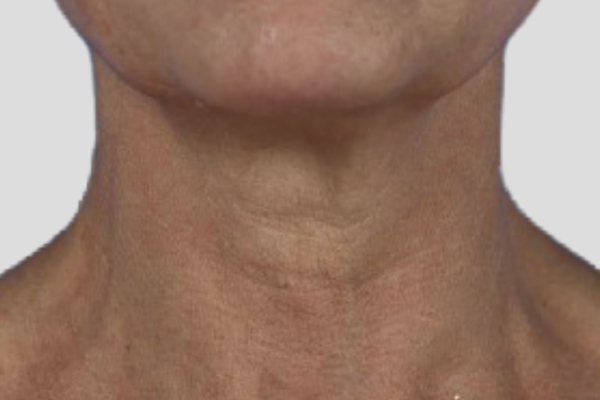 After treatment: Before and after RF Microneedling - 3 Treatments of Sylfirm X RF Microneedling with Exosomes - Oconomowoc WI