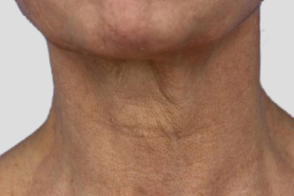 Before treatment: Before and after RF Microneedling - 3 Treatments of Sylfirm X RF Microneedling with Exosomes - Oconomowoc WI