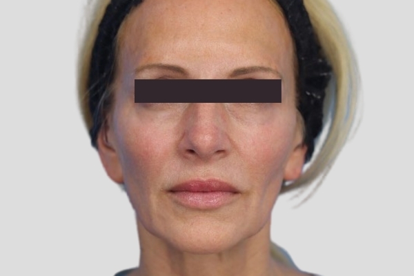 After treatment: Before and after RF Microneedling - 3 Treatments of Sylfirm X RF Microneedling with Exosomes - Waukesha WI