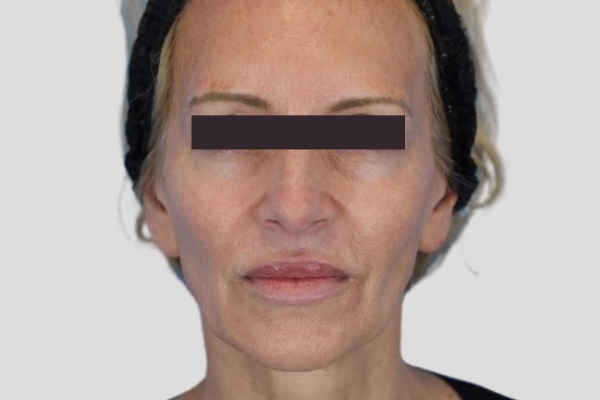 Before treatment: Before and after RF Microneedling - 3 Treatments of Sylfirm X RF Microneedling with Exosomes - Waukesha WI