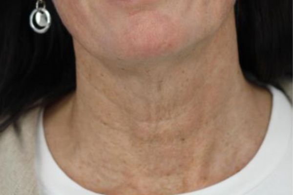 After treatment: Before and after RF Microneedling - 3 Treatments of Sylfirm X RF Microneedling with Exosomes – Delafield WI