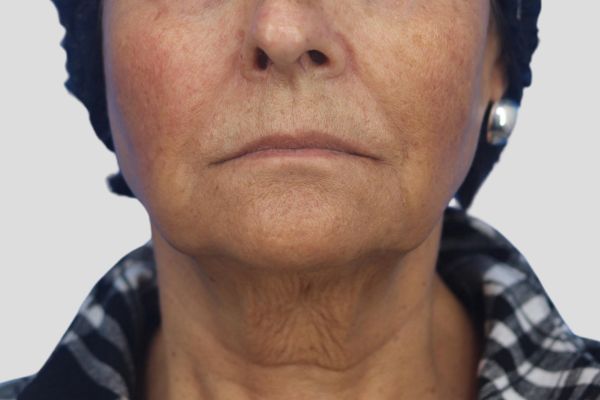 After treatment: Before and after RF Microneedling - 3 Treatments of Sylfirm X RF Microneedling with Exosomes – Waukesha WI