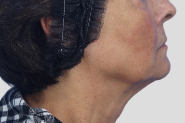 After treatment: Before and after RF Microneedling - 3 Treatments of Sylfirm X RF Microneedling with Exosomes – Brookfield WI