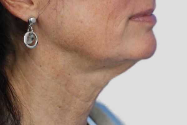 After treatment: Before and after RF Microneedling - 3 Treatments of Sylfirm X RF Microneedling with Exosomes – Delafield WI