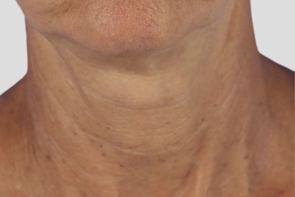 After treatment: Before and after RF Microneedling - 3 Treatments of Sylfirm X RF Microneedling with Exosomes – Brookfield WI