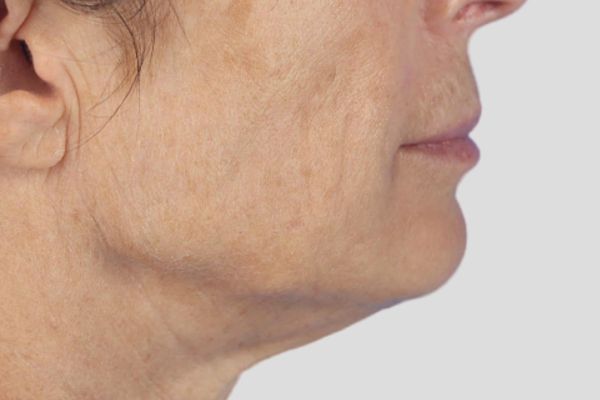 After treatment: Before and after RF Microneedling - 3 Treatments of Sylfirm X RF Microneedling with Exosomes – Brookfield WI