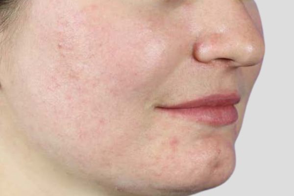 After treatment: Before and after RF Microneedling - 3 Treatments of Sylfirm X RF Microneedling with Exosomes – Brookfield WI