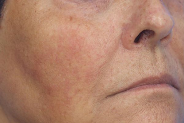 After treatment: Before and after RF Microneedling - 3 Treatments of Sylfirm X RF Microneedling with Exosomes – Brookfield WI
