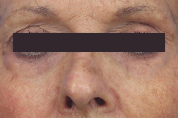 After treatment: Before and after RF Microneedling - 3 Treatments of Sylfirm X RF Microneedling with Exosomes – Brookfield WI