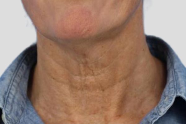 Before treatment: Before and after RF Microneedling - 3 Treatments of Sylfirm X RF Microneedling with Exosomes – Delafield WI