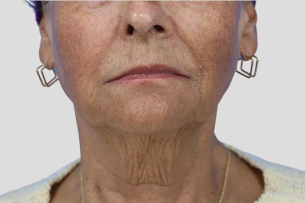 Before treatment: Before and after RF Microneedling - 3 Treatments of Sylfirm X RF Microneedling with Exosomes – Waukesha WI
