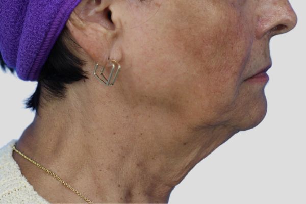 Before treatment: Before and after RF Microneedling - 3 Treatments of Sylfirm X RF Microneedling with Exosomes – Brookfield WI