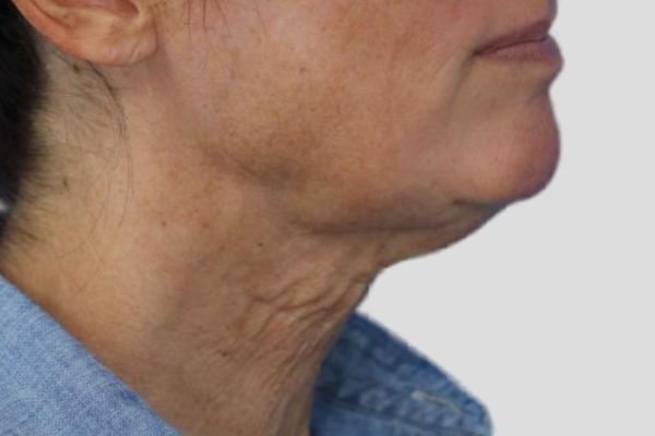 Before treatment: Before and after RF Microneedling - 3 Treatments of Sylfirm X RF Microneedling with Exosomes – Delafield WI