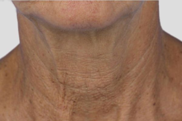 Before treatment: Before and after RF Microneedling - 3 Treatments of Sylfirm X RF Microneedling with Exosomes – Brookfield WI