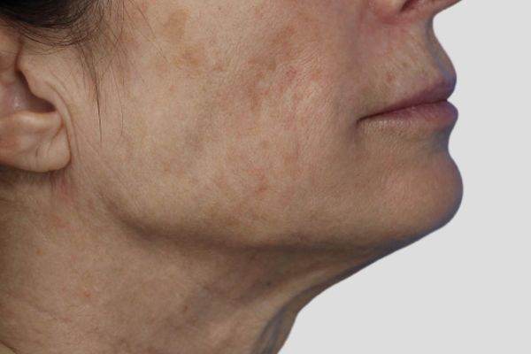 Before treatment: Before and after RF Microneedling - 3 Treatments of Sylfirm X RF Microneedling with Exosomes – Brookfield WI
