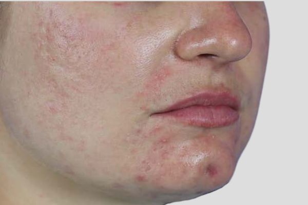 Before treatment: Before and after RF Microneedling - 3 Treatments of Sylfirm X RF Microneedling with Exosomes – Brookfield WI