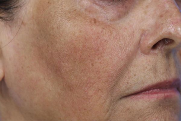 Before treatment: Before and after RF Microneedling - 3 Treatments of Sylfirm X RF Microneedling with Exosomes – Brookfield WI