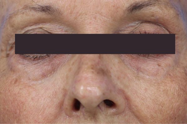 Before treatment: Before and after RF Microneedling - 3 Treatments of Sylfirm X RF Microneedling with Exosomes – Brookfield WI