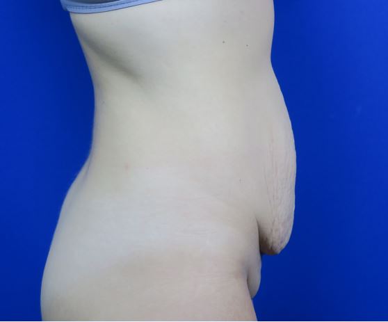 Before treatment: Affordable Milwaukee-Area Tummy Tuck