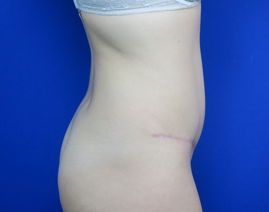 After treatment: Affordable Milwaukee-Area Tummy Tuck