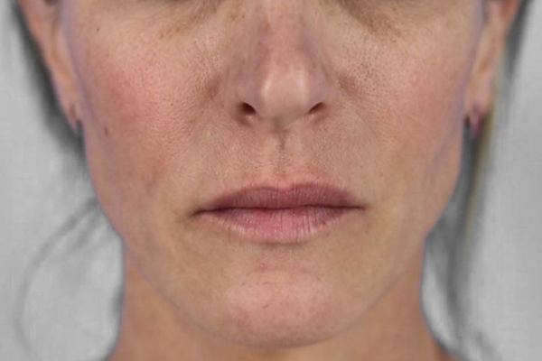 Before treatment: Sculptra before and after - improved facial volume and firmness, Brookfield WI
