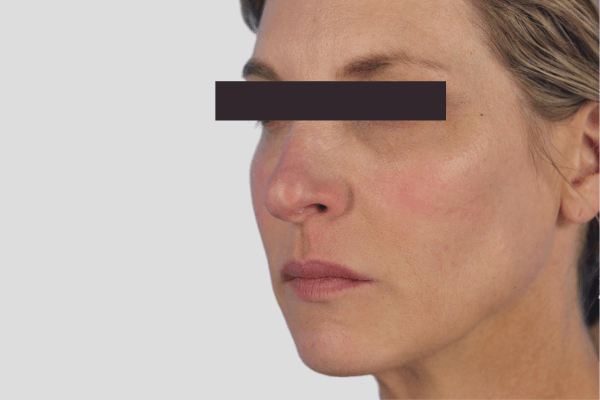 After treatment: Sculptra before and after - improved facial volume and firmness, Waukesha WI