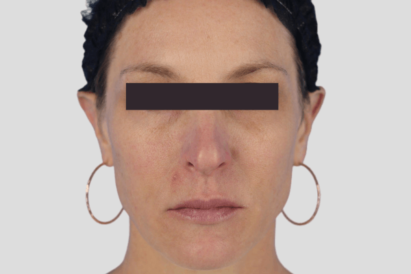 Before treatment: Sculptra before and after - improved facial volume and firmness, Milwaukee WI