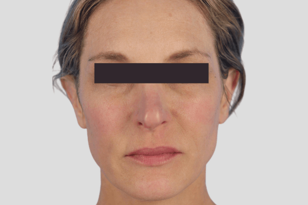 After treatment: Sculptra before and after - improved facial volume and firmness, Milwaukee WI