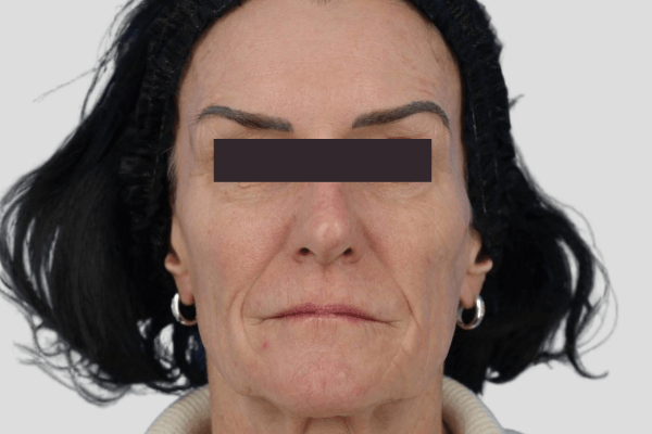 Before treatment: Sculptra before and after - improved facial volume and firmness, Oconomowoc WI