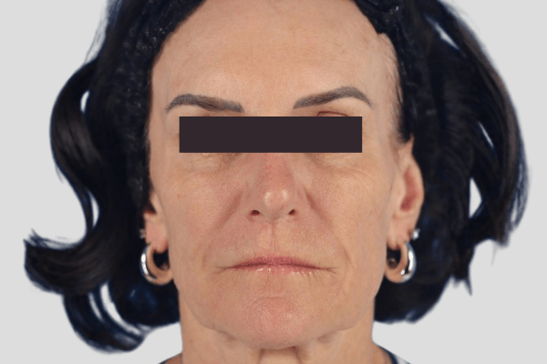 After treatment: Sculptra before and after - improved facial volume and firmness, Oconomowoc WI