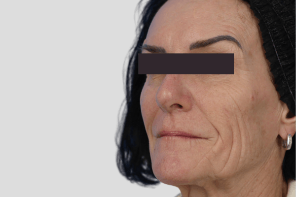 Before treatment: Sculptra before and after - improved facial volume and firmness, Delafield WI