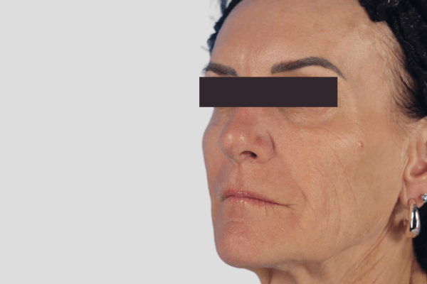 After treatment: Sculptra before and after - improved facial volume and firmness, Delafield WI