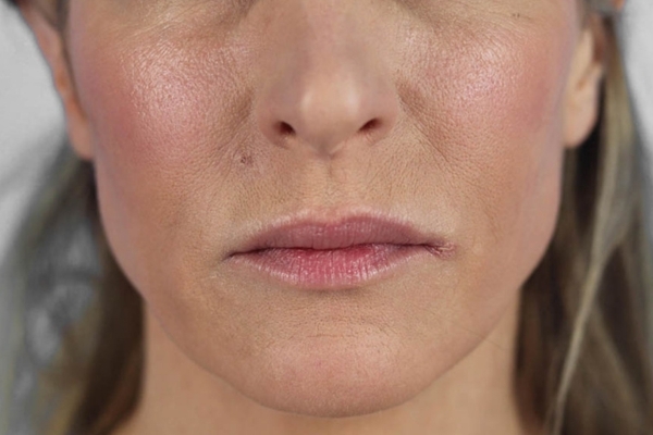 After treatment: Sculptra before and after - improved facial volume and firmness, Brookfield WI