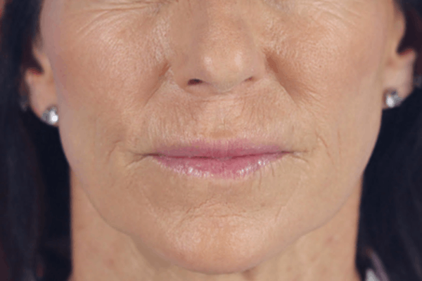 After treatment: Sculptra before and after - improved facial volume and firmness, Milwaukee WI
