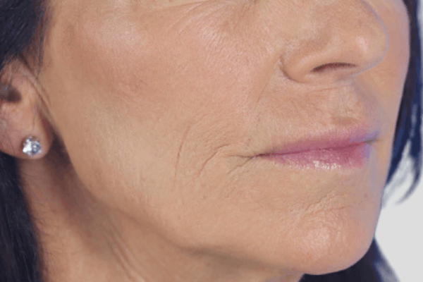 After treatment: Sculptra before and after - improved facial volume and firmness, Waukesha WI