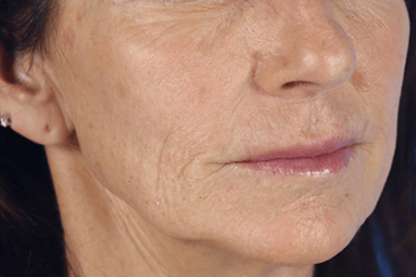 Before treatment: Sculptra before and after - improved facial volume and firmness, Waukesha WI