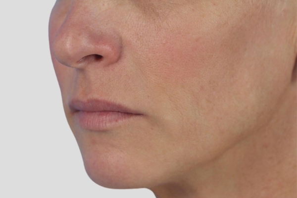 Before treatment: Sculptra before and after - improved facial volume and firmness, Brookfield WI