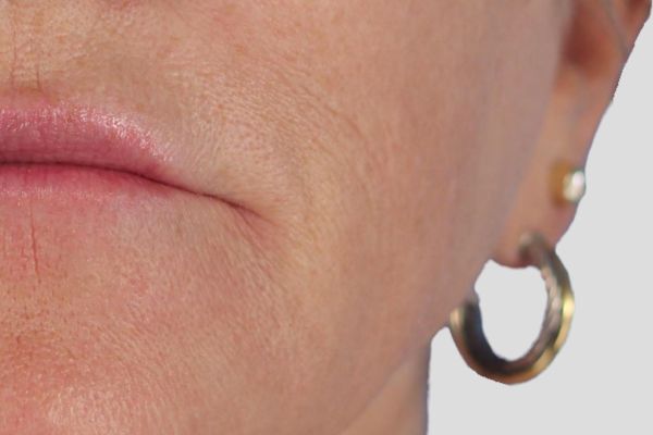 After treatment: Sculptra before and after - improved facial volume and firmness, Delafield WI